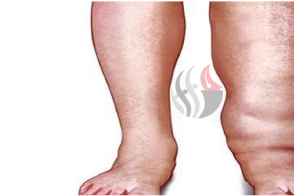 सर्लाहीमा चार लाखभन्दा बढीलाई हात्तीपाइलेविरुद्धको औषधि खुवाइने